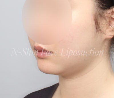 이중턱 지방흡입 50cc, 수술 전부터 3개월차까지 사진 4