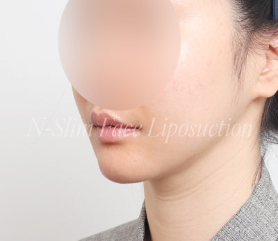 이중턱 지방흡입 50cc, 수술 전부터 3개월차까지 사진 5
