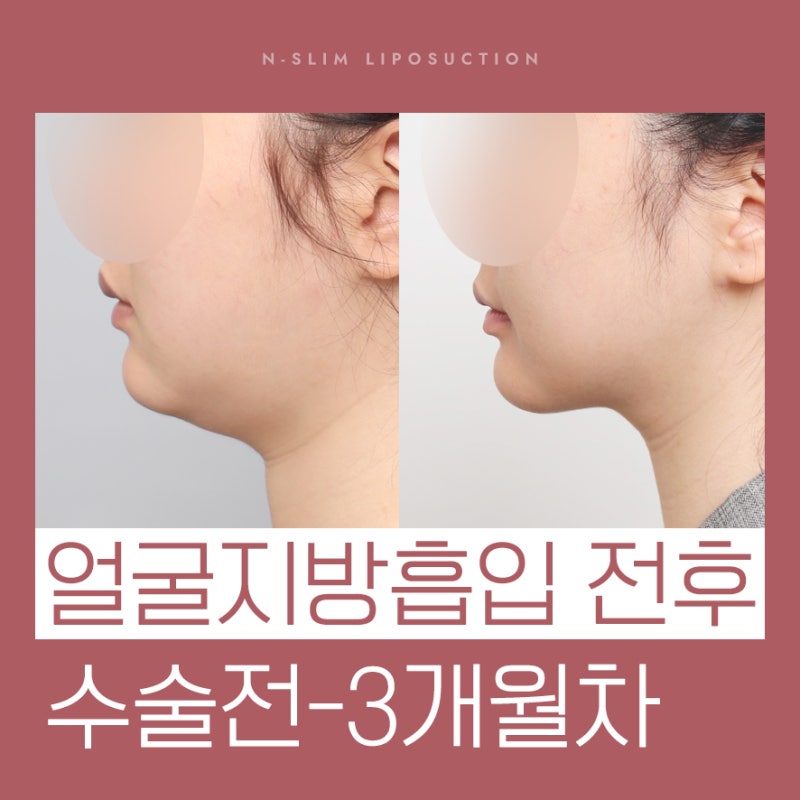 이중턱 지방흡입 50cc, 수술 전부터 3개월차까지