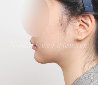 이중턱 지방흡입 50cc, 수술 전부터 3개월차까지 사진 3