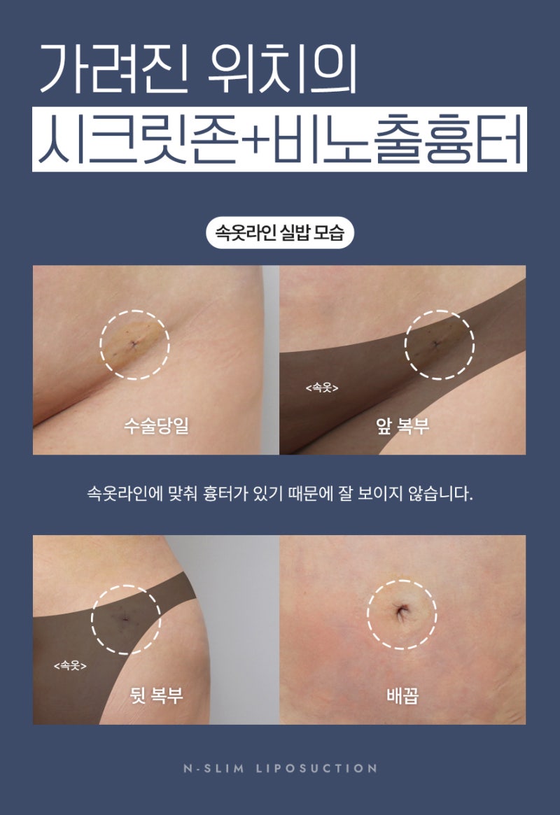 복부 지방흡입 2400cc 실제 사례 사진 10