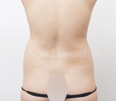 복부 지방흡입 2400cc 실제 사례 사진 8