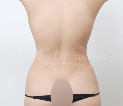 복부 지방흡입 2400cc 실제 사례 사진 9