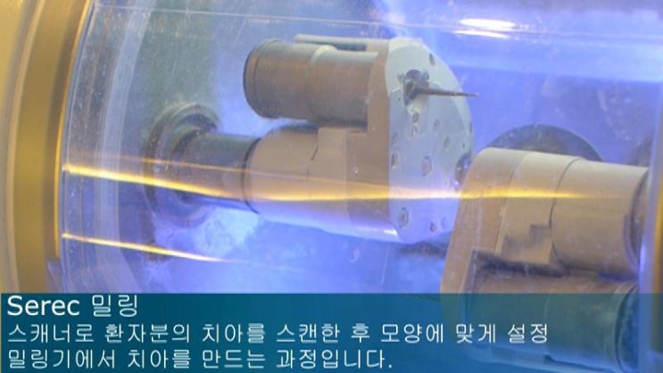 [원데이치과/원데이임플란트]원데이임플란트가 가능한이유- 세렉