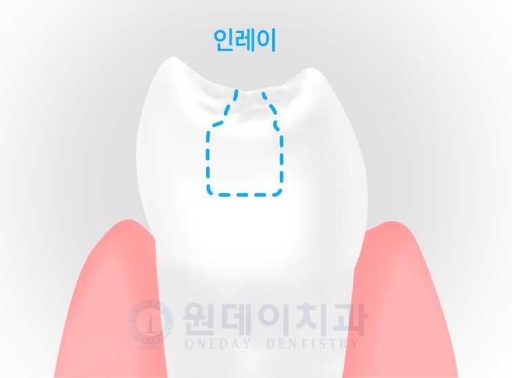 충치치료를 빨리해야 하는 이유