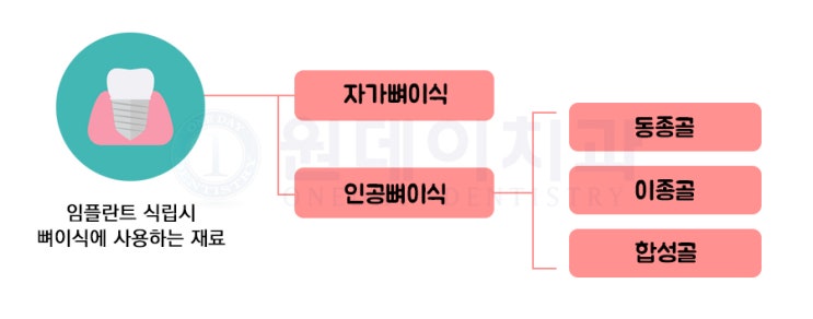 임플란트는 어떻게 생겼을까? 뼈이식은 꼭 해야하나?