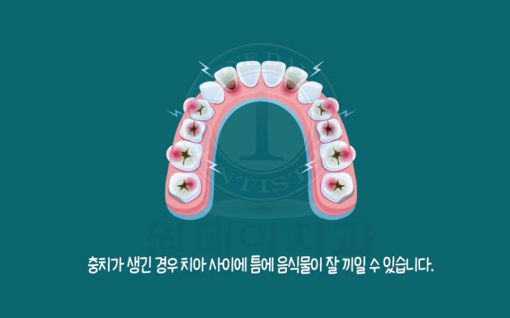 치아 사이에 음식물이 잘 끼일 때 치아 사이를 매우면 괜찮을까?
