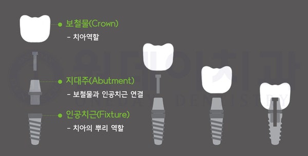[원데이치과 원데이임플란트] 절개 임플란트 시술과 무절개 임플란트 시술, 그리고 물방울 레이저 시술의 비교