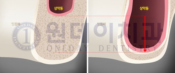 어금니임플란트, 걱정하지마세요 상악동 거상술로 윗 어금니 임플란트도 당일치료 하세요.