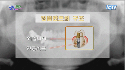 강남구임플란트과정 및 관리 방법 등을 알아보고 사진 12