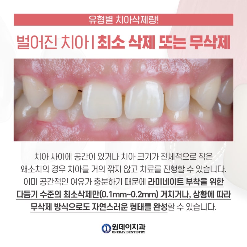 【ワンデイ歯科】ラミネートベニア、自分の歯はどれくらい削るべき？