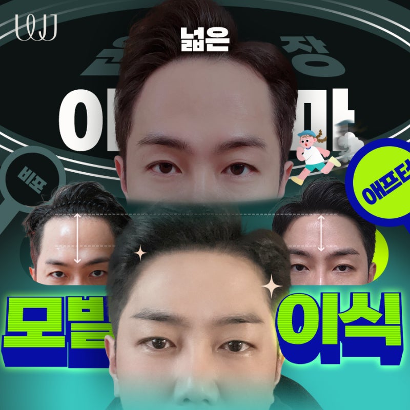 넓은 이마 비절개모발이식 전후와 회복과정