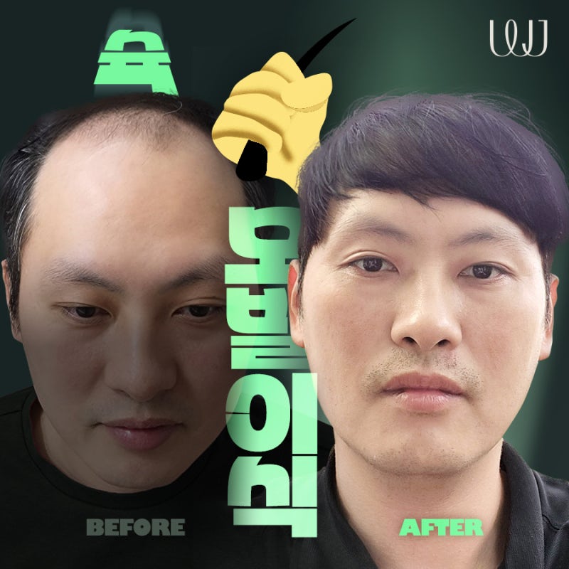절개모발이식 전후로 알아보는 회복과정