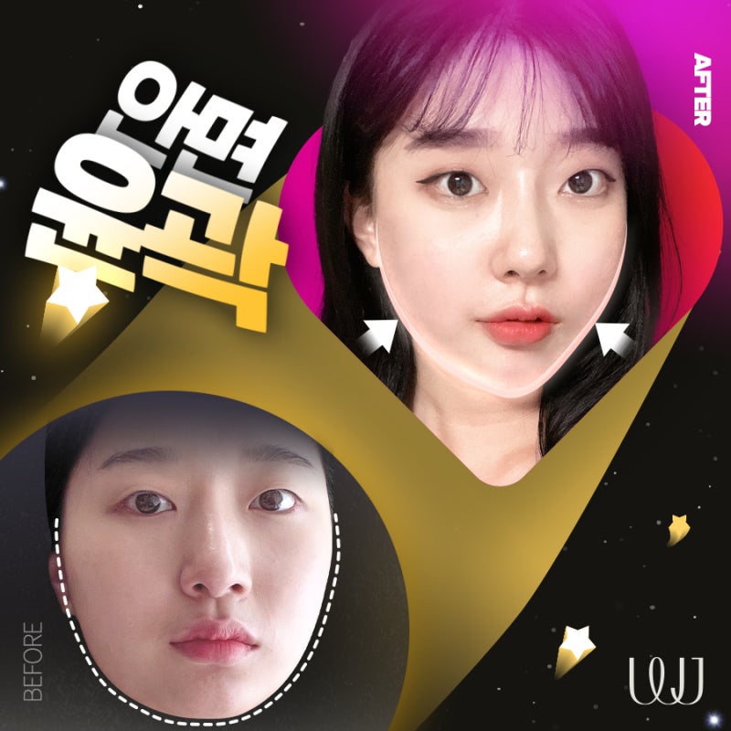 안면윤곽 전후사진과 회복과정