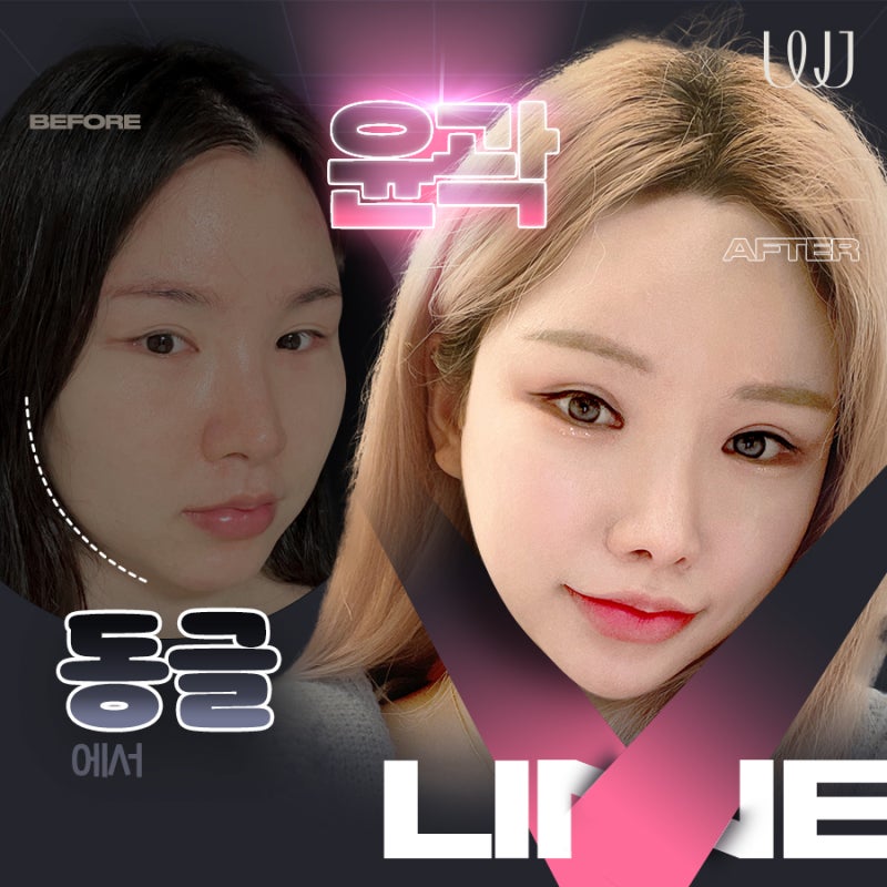 얼굴형 콤플렉스 윤곽 전후와 회복과정