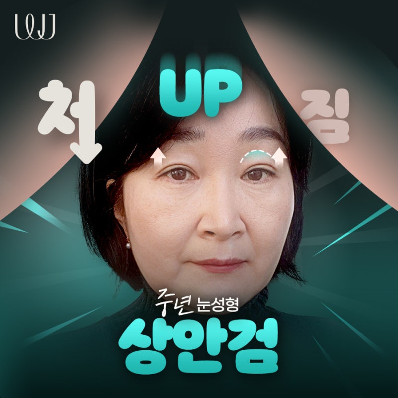 중년눈매교정 처진눈꺼풀은 상안검수술