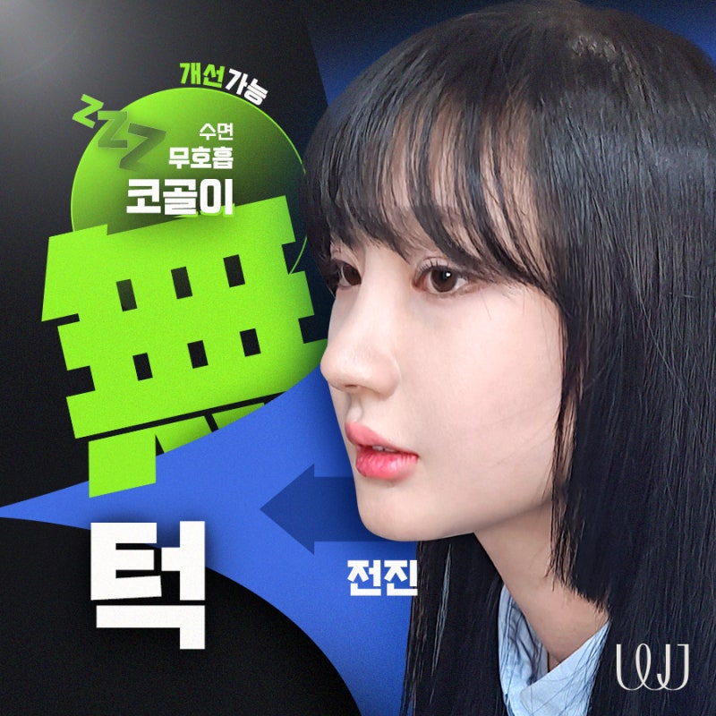 코골이를 동반하는 무턱수술 방법은?