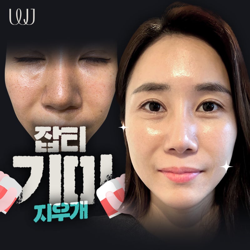 기미 주근깨 색소치료 전후, 깨끗해진 피부