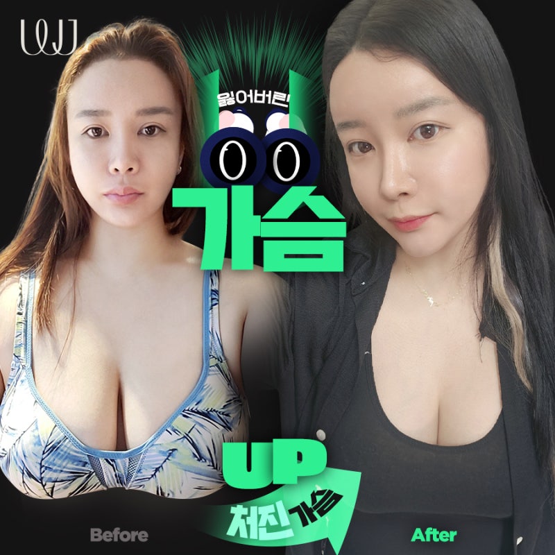 출산과 모유수유 후 처진 가슴성형 전후