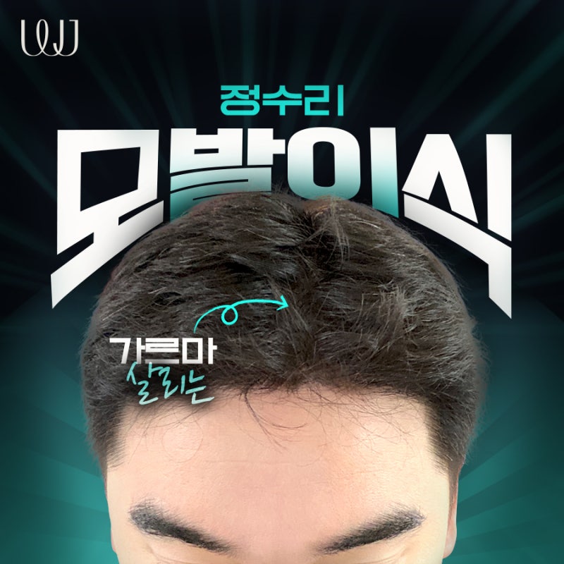 정수리탈모 모발이식으로 풍성하게