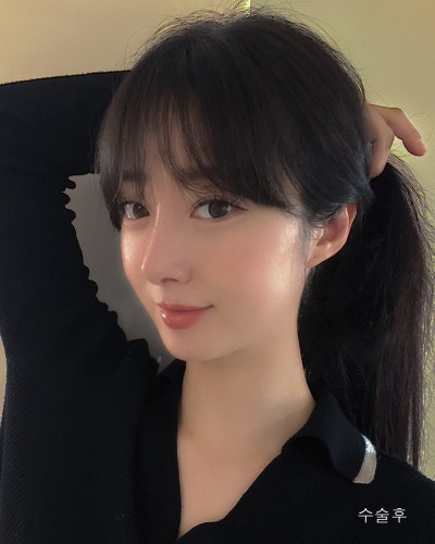 휜코 처진코끝 자려한코성형 전후 사진 5