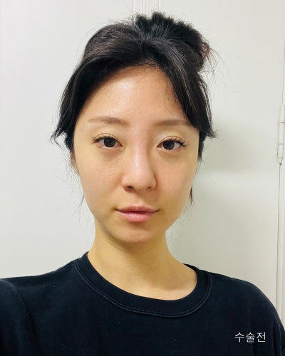 휜코 처진코끝 자려한코성형 전후 사진 2