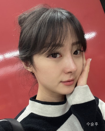 휜코 처진코끝 자려한코성형 전후 사진 7