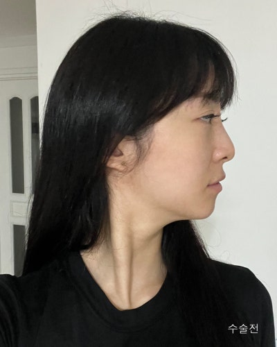 휜코 처진코끝 자려한코성형 전후 사진 8