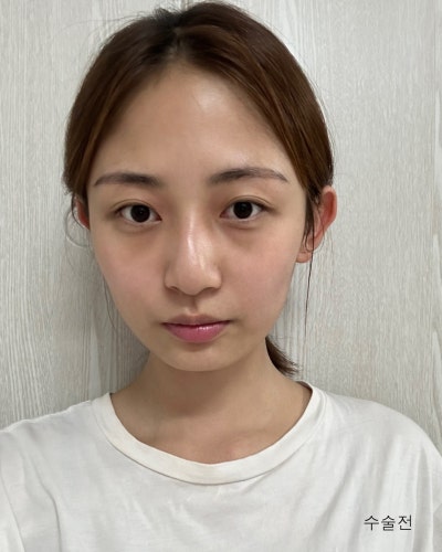 코성형 하나로 달라진 이미지 매부리코 직반코성형 전후 사진 8