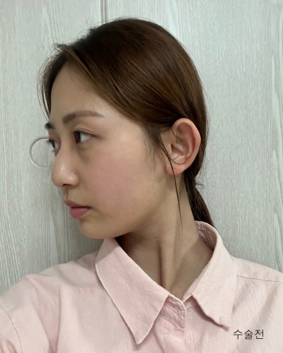 코성형 하나로 달라진 이미지 매부리코 직반코성형 전후 사진 10