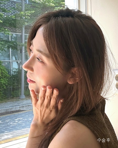 코성형 하나로 달라진 이미지 매부리코 직반코성형 전후 사진 11