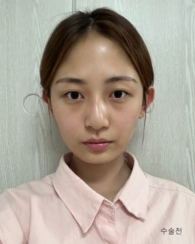 코성형 하나로 달라진 이미지 매부리코 직반코성형 전후 사진 2