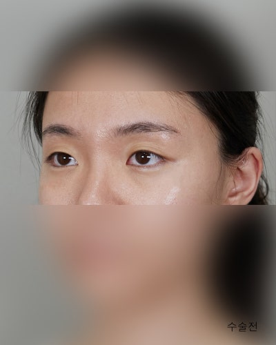 겹주름 졸린눈을 또렷하게 비절개눈매교정 전후 사진 4