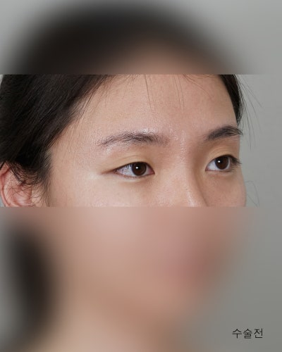 겹주름 졸린눈을 또렷하게 비절개눈매교정 전후 사진 6