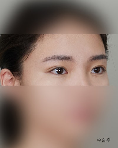 겹주름 졸린눈을 또렷하게 비절개눈매교정 전후 사진 7