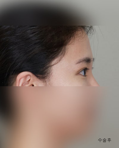 겹주름 졸린눈을 또렷하게 비절개눈매교정 전후 사진 9