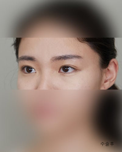 겹주름 졸린눈을 또렷하게 비절개눈매교정 전후 사진 5