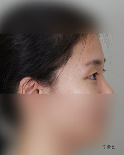 겹주름 졸린눈을 또렷하게 비절개눈매교정 전후 사진 8