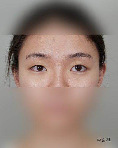 겹주름 졸린눈을 또렷하게 비절개눈매교정 전후 사진 2
