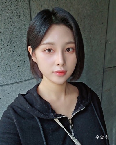 풀린눈재수술, 이마거상, 코성형 전후 사진 3