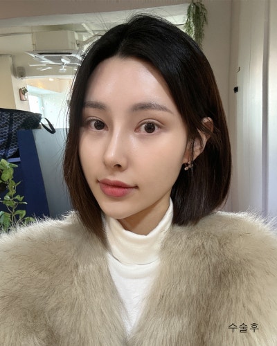 풀린눈재수술, 이마거상, 코성형 전후 사진 9
