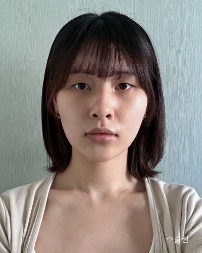 풀린눈재수술, 이마거상, 코성형 전후 사진 6