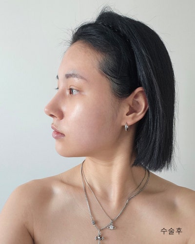 풀린눈재수술, 이마거상, 코성형 전후 사진 11