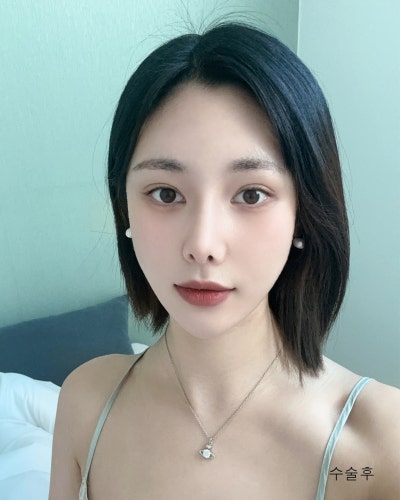 풀린눈재수술, 이마거상, 코성형 전후 사진 5