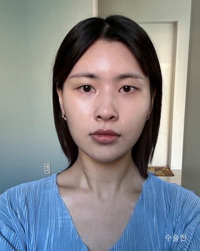 풀린눈재수술, 이마거상, 코성형 전후 사진 4