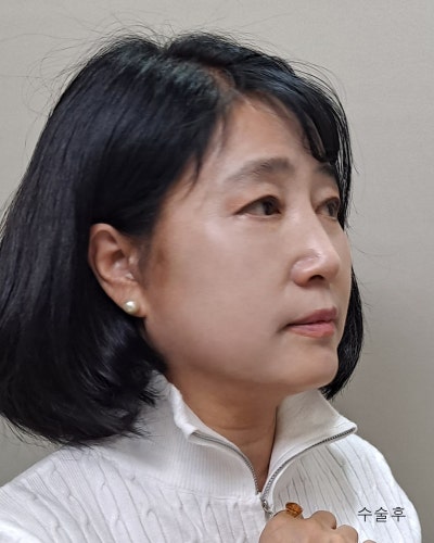 중년성형 안면거상,이마거상,눈매교정,하안검 전후 사진 5