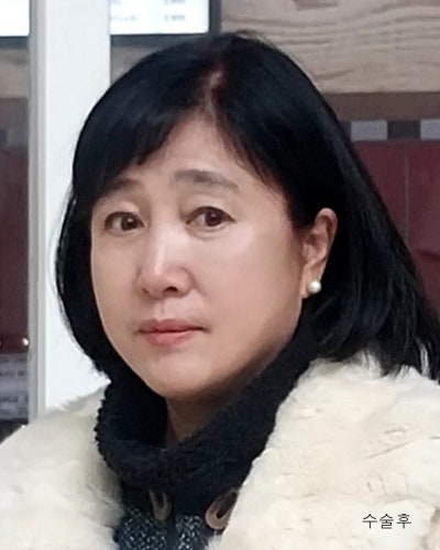중년성형 안면거상,이마거상,눈매교정,하안검 전후 사진 7