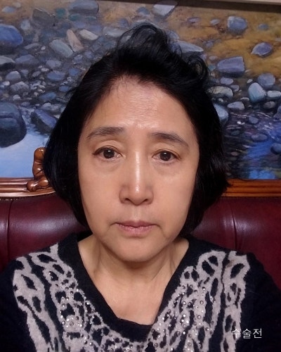 중년성형 안면거상,이마거상,눈매교정,하안검 전후 사진 2