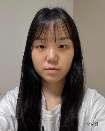 부분절개 눈매교정, 낮은코성형 전후 사진 2