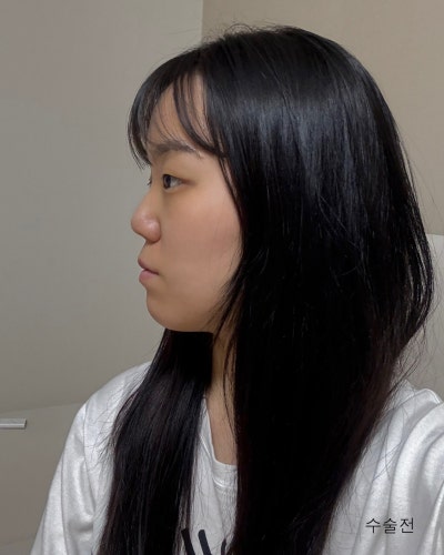 부분절개 눈매교정, 낮은코성형 전후 사진 8